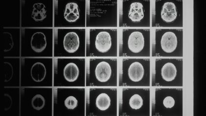 How brain-computer interfaces are moving from the lab to everyday medicine