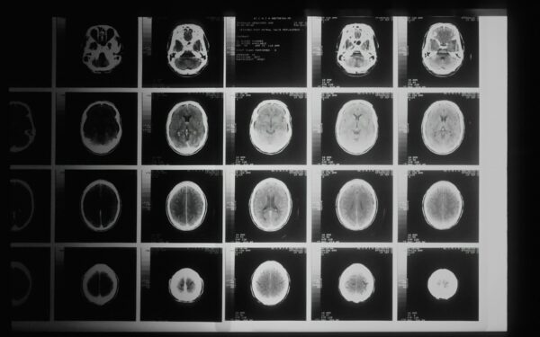 How brain-computer interfaces are moving from the lab to everyday medicine